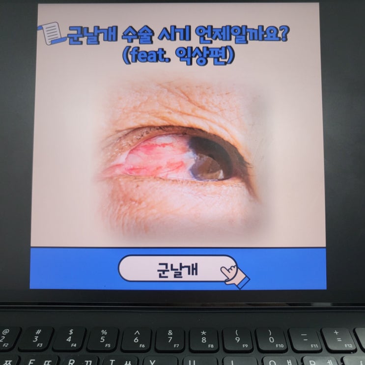  군날개 수술 시기 언제일까요?(feat. 익상편)