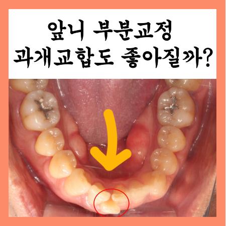  앞니 부분교정후기, 과개교합까지 개선한 전후 사진 비교