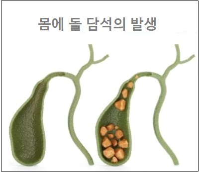  몸에 돌 담석의 발생 상식