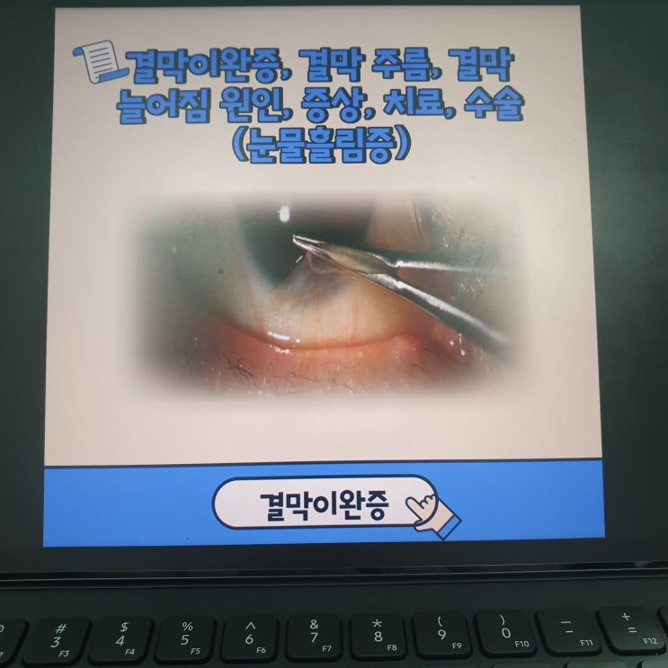  결막이완증, 결막 주름, 결막 늘어짐 원인, 증상, 치료, 수술(눈물흘림증)