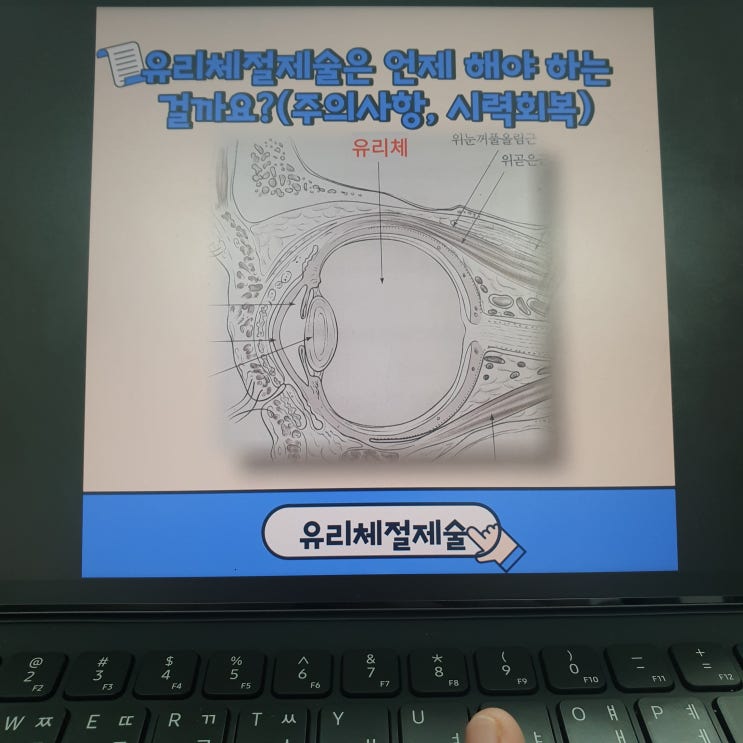  유리체절제술은 언제 해야 하는 걸까요?(주의사항, 시력회복)