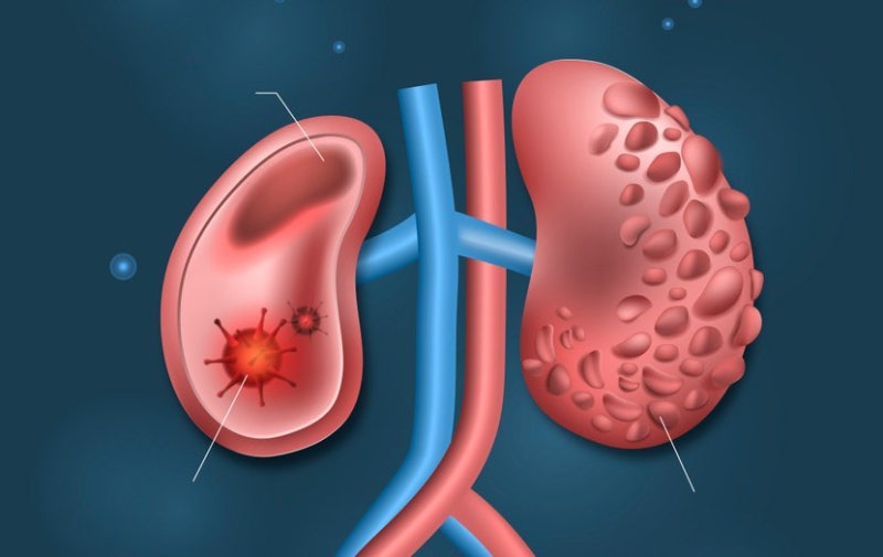 단백뇨 원인 및 증상과 치료, 검사 수치, 식단 : 요단백 의심(양성 약양성) : 네이버 블로그