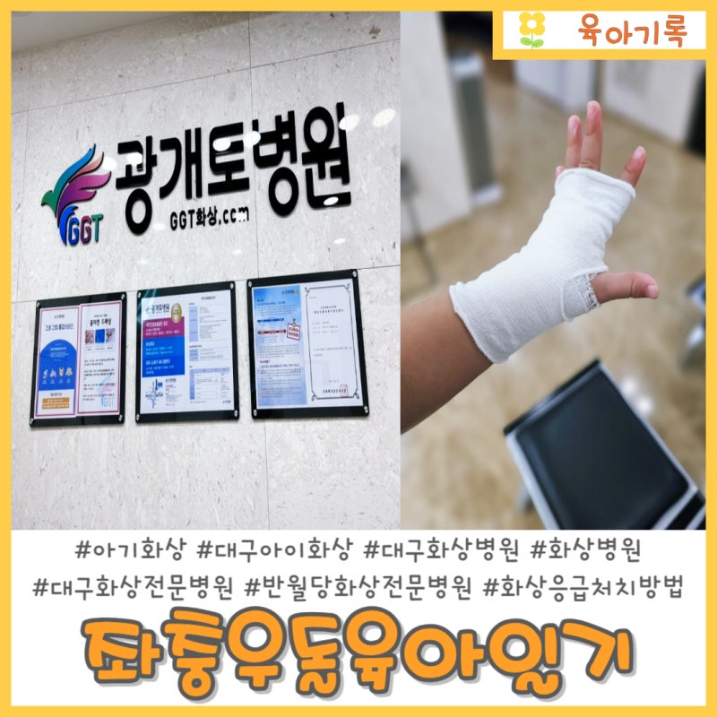 아기화상 반월당역 대구 광개토병원 화상전문병원(응급처치)