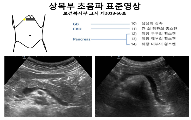 복부 초음파에 대해 알아봅시다 - 간,담낭,췌장,비장 스캔법 / 건강검진 : 네이버 블로그