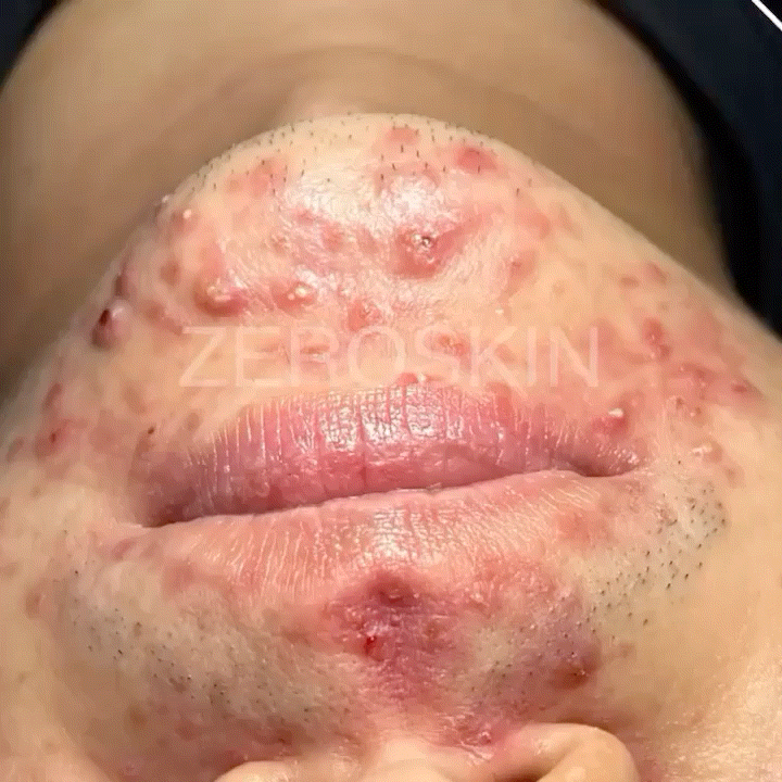  진해피부관리, 여드름 관리 다해본 사람이 직접 찾은 잘하는 곳