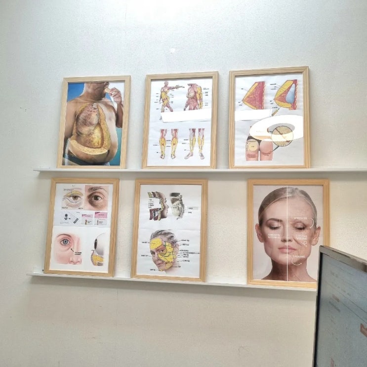60대 상안검수술, 하안검수술 내돈내산 두달차 후기 (전후비교, 효과, 붓기)