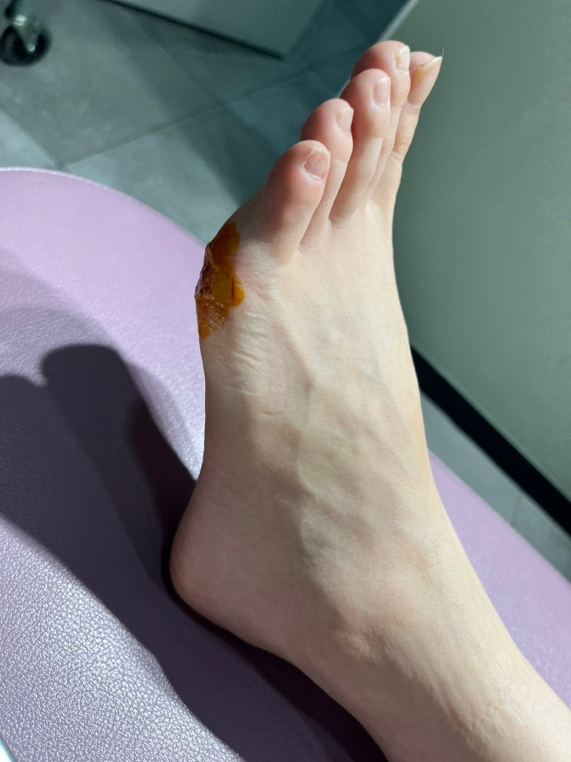 발바닥 티눈 제거 (레이저 후기 및 통증, 관리 주의점)