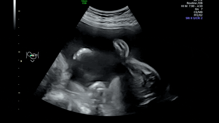 임신 22주 정밀초음파 후기, 활발한 태동 증상