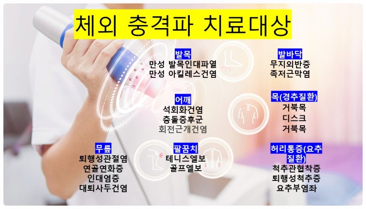  수색신경외과!  만성 근골격계 질환에 특히 효과적인 체외충격파(ESWT)