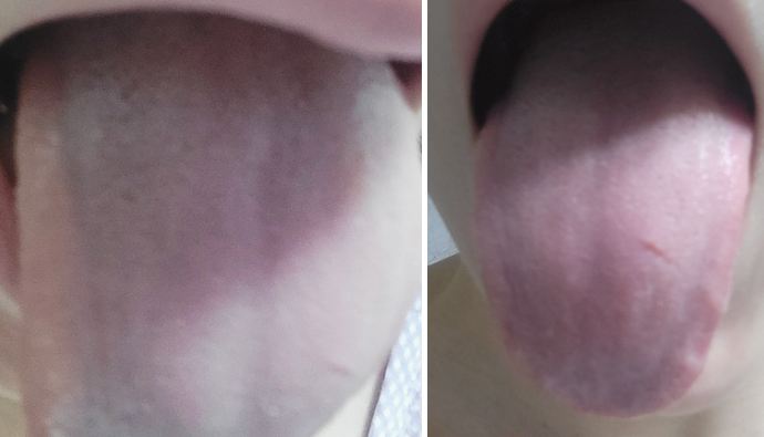 이지텅 액체 혀클리너로 혀백태제거 성공