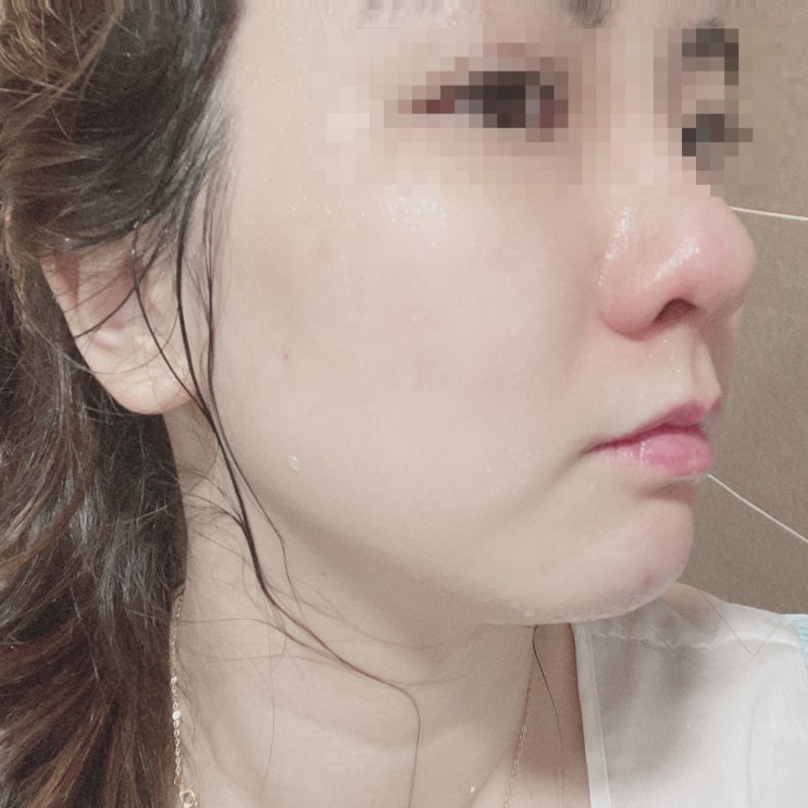  서면피부과 여드름관리 프리모PTT 치료 받은 후기