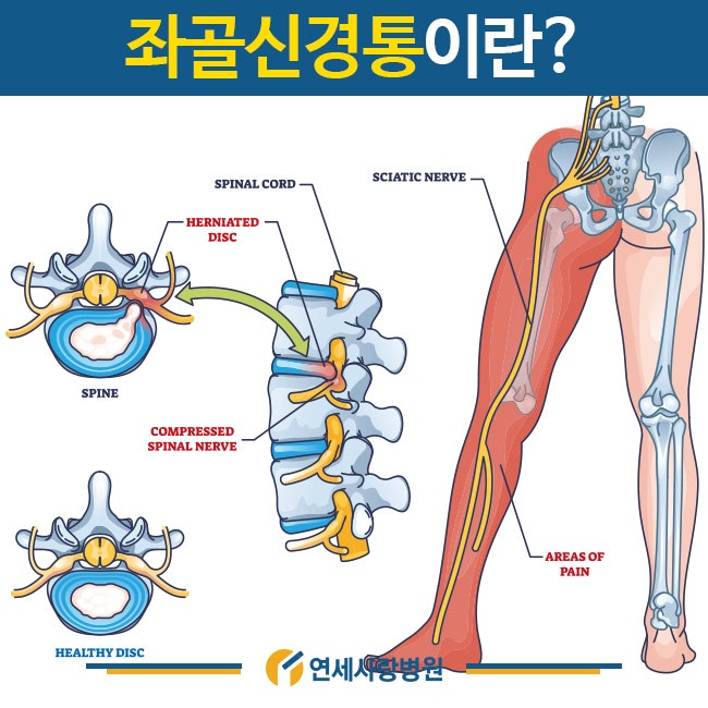 좌골신경통 증상과 치료방법은 이렇습니다 : 네이버 블로그