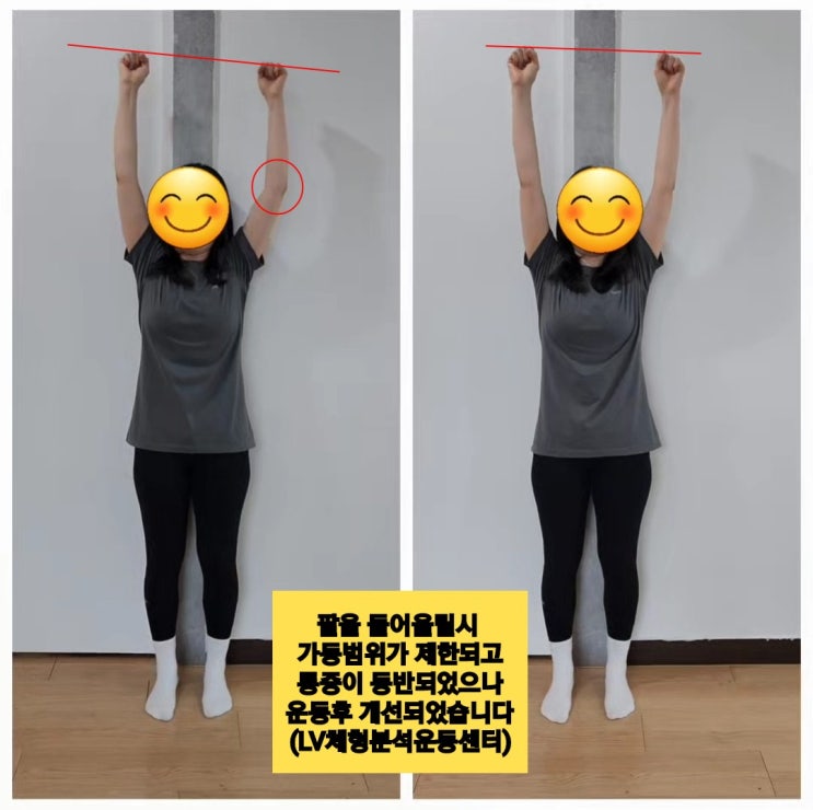  [부산사직동재활운동]어깨와 견갑골주변의 불편함과 통증을 호소하며 30대여성분이 내방해주셨어요.