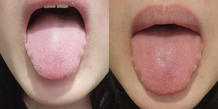  백태제거 방법 이것저것 도전하다 정착한 이지텅 혀클리너