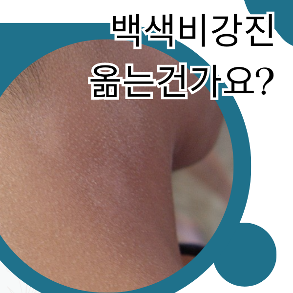  백색비강진 백색잔비늘증 마른버짐 원인과 치료법