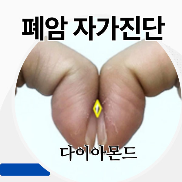  곤봉지 손가락 곤봉증 핑거클러빙 폐암 자가진단