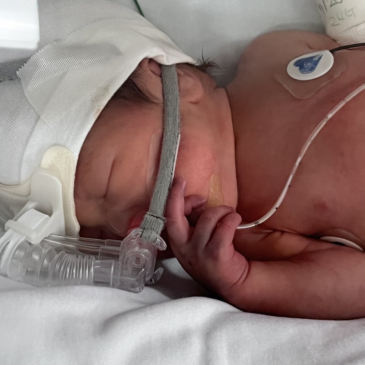  보라매병원 신생아중환자실 조산아 NICU 케어 잘 받는 중