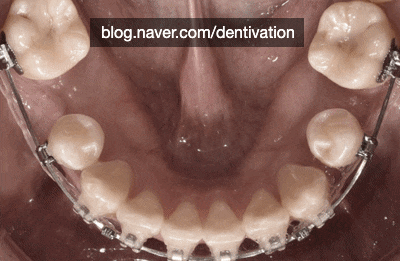 발치교정 치아가 움직이는 과정! 이를 뽑은 자리는 어떻게 없어지나요?
