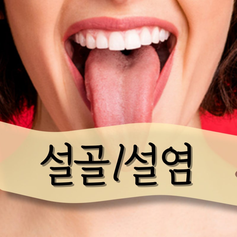 설골 설유두 설염 치료 방법