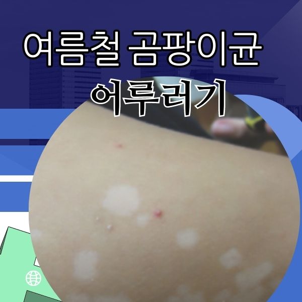  어우러기 피부 어루러기 곰팡이감염증 자가치료