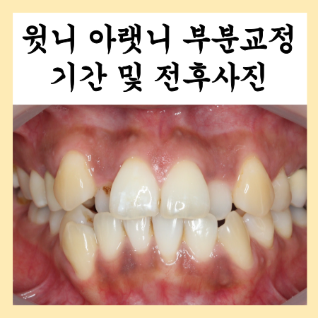  윗니 아랫니 부분교정 기간과 방법 소개, 중계동교정치과
