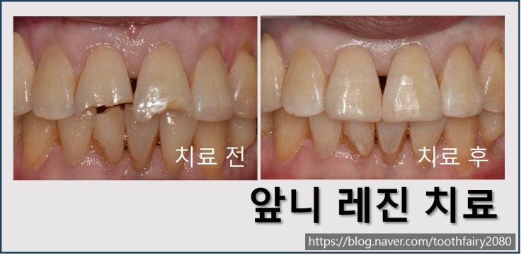 [앞니 레진 치료] 치아가 깨졌어요. 레진 치료의 장단점