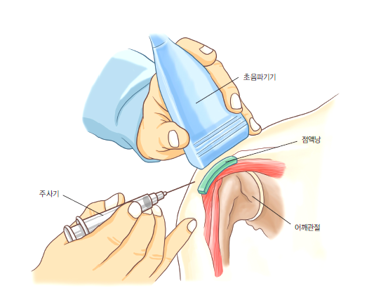  수성구 어깨병원 어깨 치료 잘하는 곳 선택하는 TIP