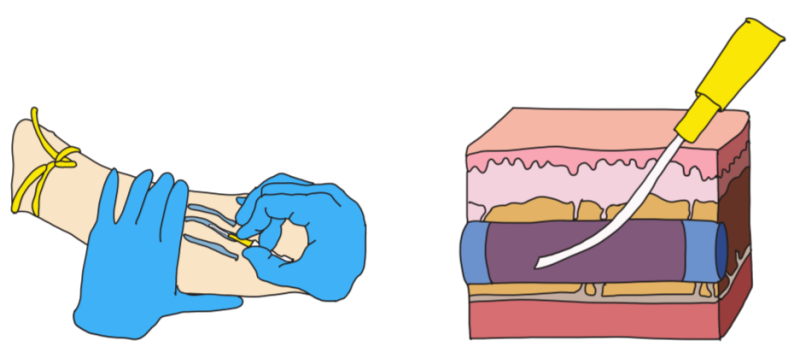 IV(intravenous), 정맥주사 고수되기 : 좋은 혈관 찾기 : 네이버 블로그