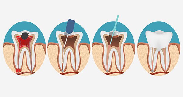 치과 신경치료는 무얼 하는 치료일까요? 신경치료는 신경을 "죽이는" 것인가요? 근관치료에 대해서