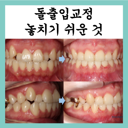  돌출입 발치교정 후기 및 기간, 자칫 놓치기 쉬운것들