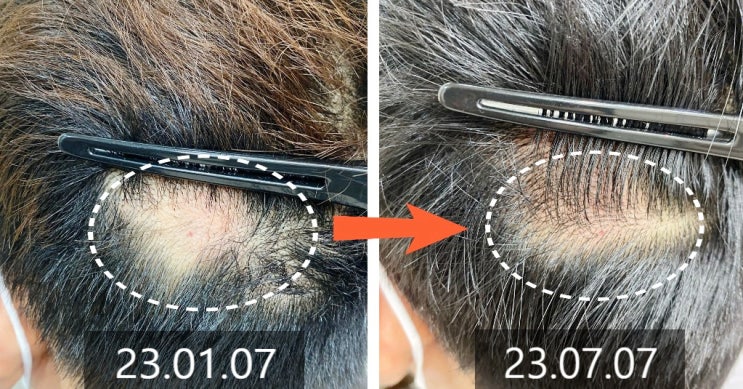  반복 발생하는 원형탈모, 홍대 원형탈모 치료 전후의 변화