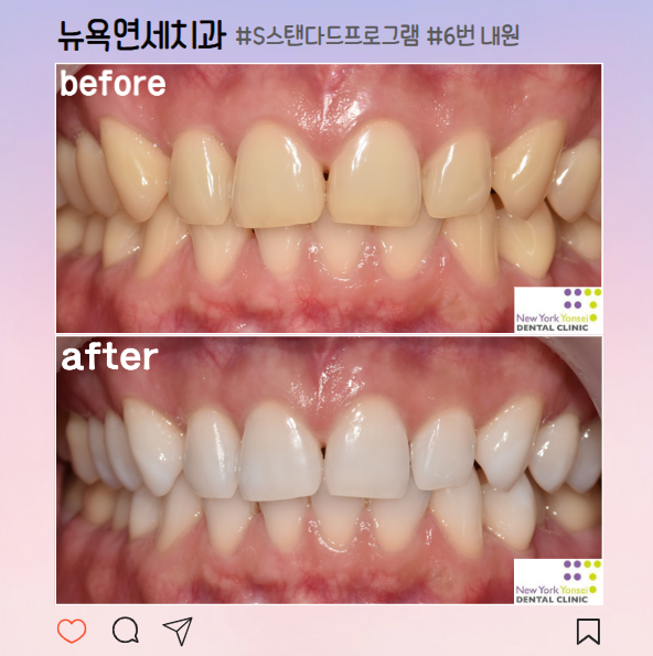 [강남역 치아미백] 효과 좋은 치과 미백 솔직 후기!(전, 후 비교)