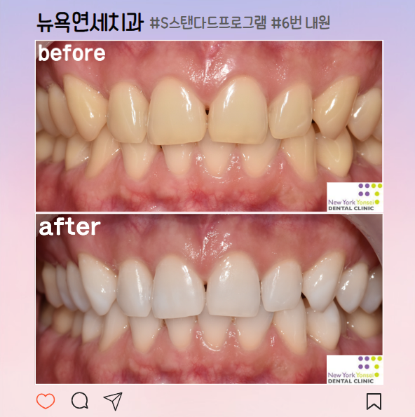  [강남역 치아미백] 효과 좋은 치과 미백 솔직 후기!(전, 후 비교)
