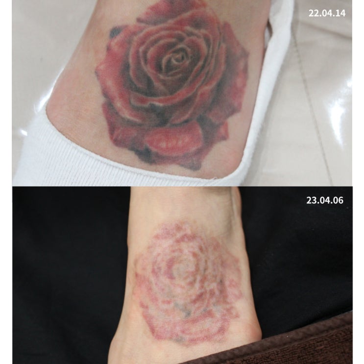 부산 타투제거가격 보다 먼저 확인해야 하는 2가지 부산 타투제거가격 보다 먼저 확인해야 하는 2가지
