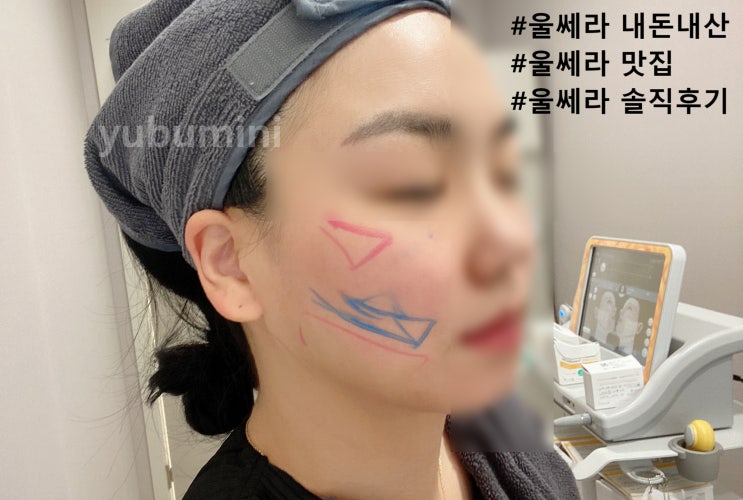  [압구정 피부과] 울쎄라 300샷으로 심부볼 이중턱 고민 해결한 내돈내산 솔직 후기 (feat. 도수치료)