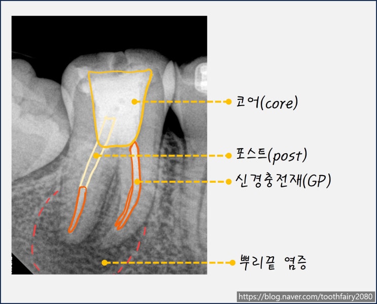 신경치료한 치아에 통증이 재발했다면?  Part1. 재신경치료