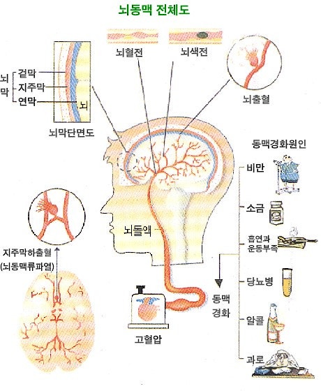  [수색 신경외과] 뇌졸증(Stroke)에 대해 간략히 알아보겠습니다.