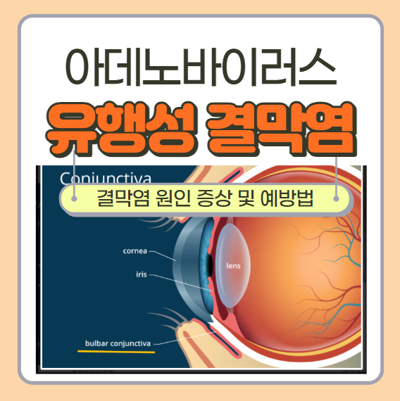  아데노바이러스 유행성 결막염 전염 급증 원인 증상 및 예방법