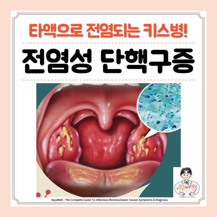  전염성 단핵구증, 감염성 단핵구증, 키스병 원인 증상 검사 치료