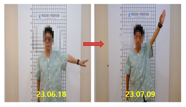  팔이 안올라가요! 부산 오십견 원인과 치료 정리