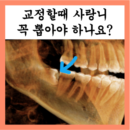  교정할때 사랑니 발치 꼭 해야할까?