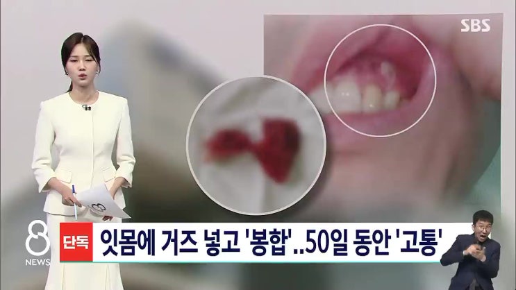 천안 대학 치과병원 의료사고 어디 잇몸에 거즈 넣고 봉합 썩어서 고름