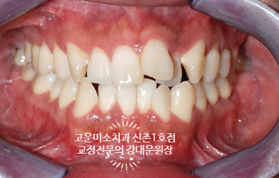  앞니돌출 과 심한 덧니, 입술 돌출및 정중선이 돌아가 있는 2급 부정교합치료증례 신촌교정치과 고운미소 신촌1호점 치료증례