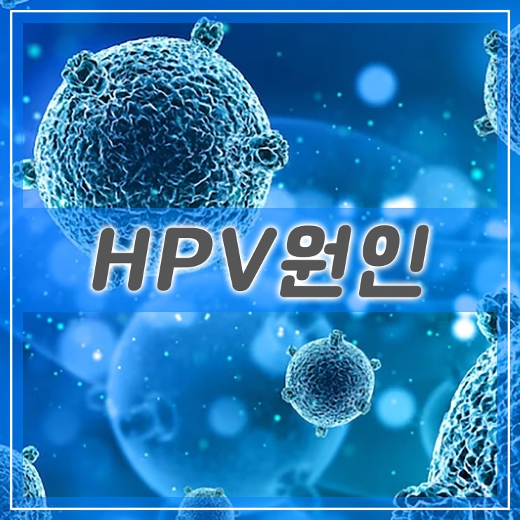 HPV 바이러스 원인과 증상 인간유두종바이러스 치료와 예방