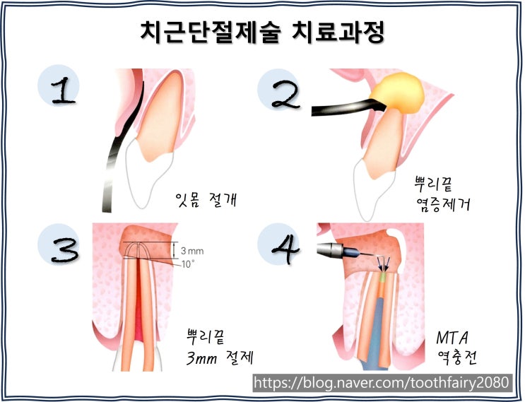  [자연치아 살리기] 신경치료한 치아가 부었어요.ㅣ염증 재발ㅣPart2. 치근단절제술