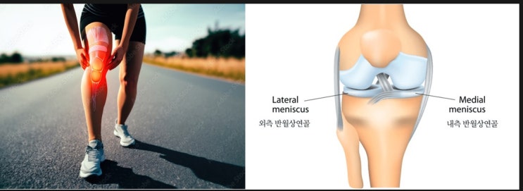  [수색 신경외과] 무릎 통증, 반월상 연골판 파열에 대해 알아보겠습니다.
