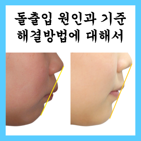  돌출입 원인과 기준 해결방법에 대해서, 창동교정치과