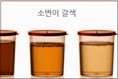  소변이 갈색 소변이 콜라색 소변 붉은색 의심 질환