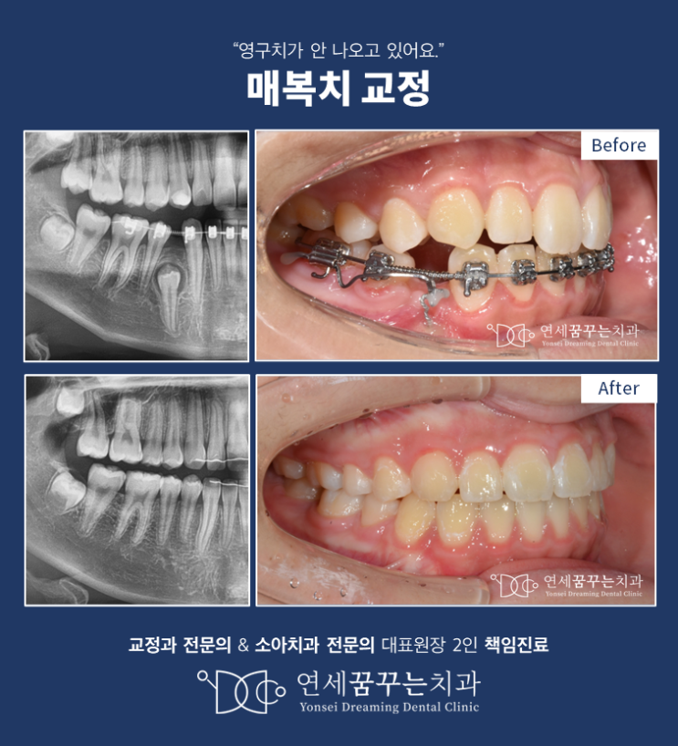 매복치 교정; 치아가 안 나와요! 치아가 매복되는 이유와 매복치 교정 성공 가능성 매복치 교정; 치아가 안 나와요! 치아가 매복되는 이유와 매복치 교정 성공 가능성