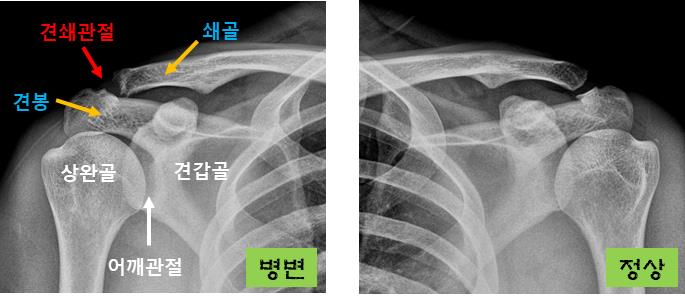  견쇄관절염, 어깨 통증과 관련이 있습니다